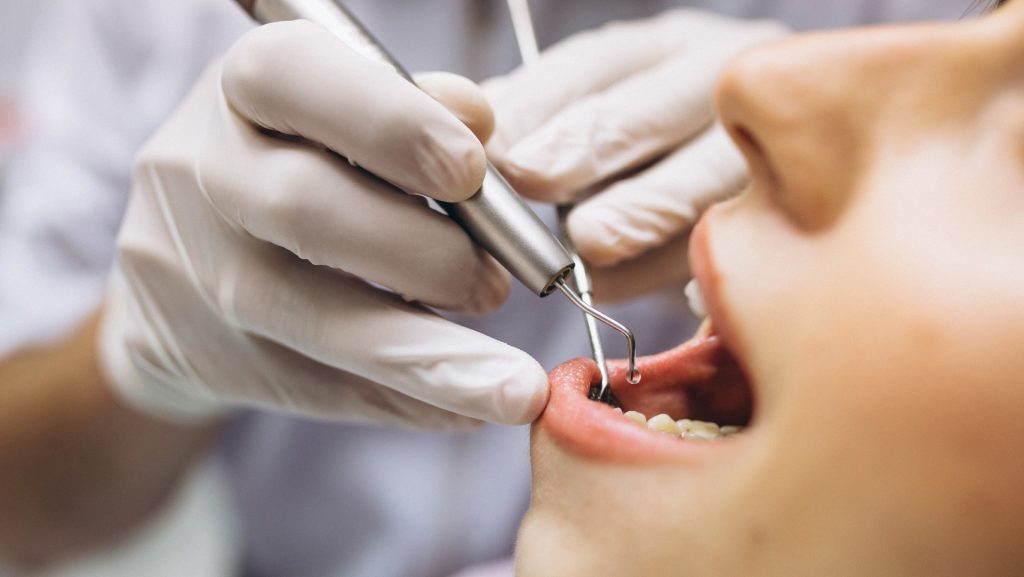 خلع جراحي لسن العقل في Mint Dental Care
