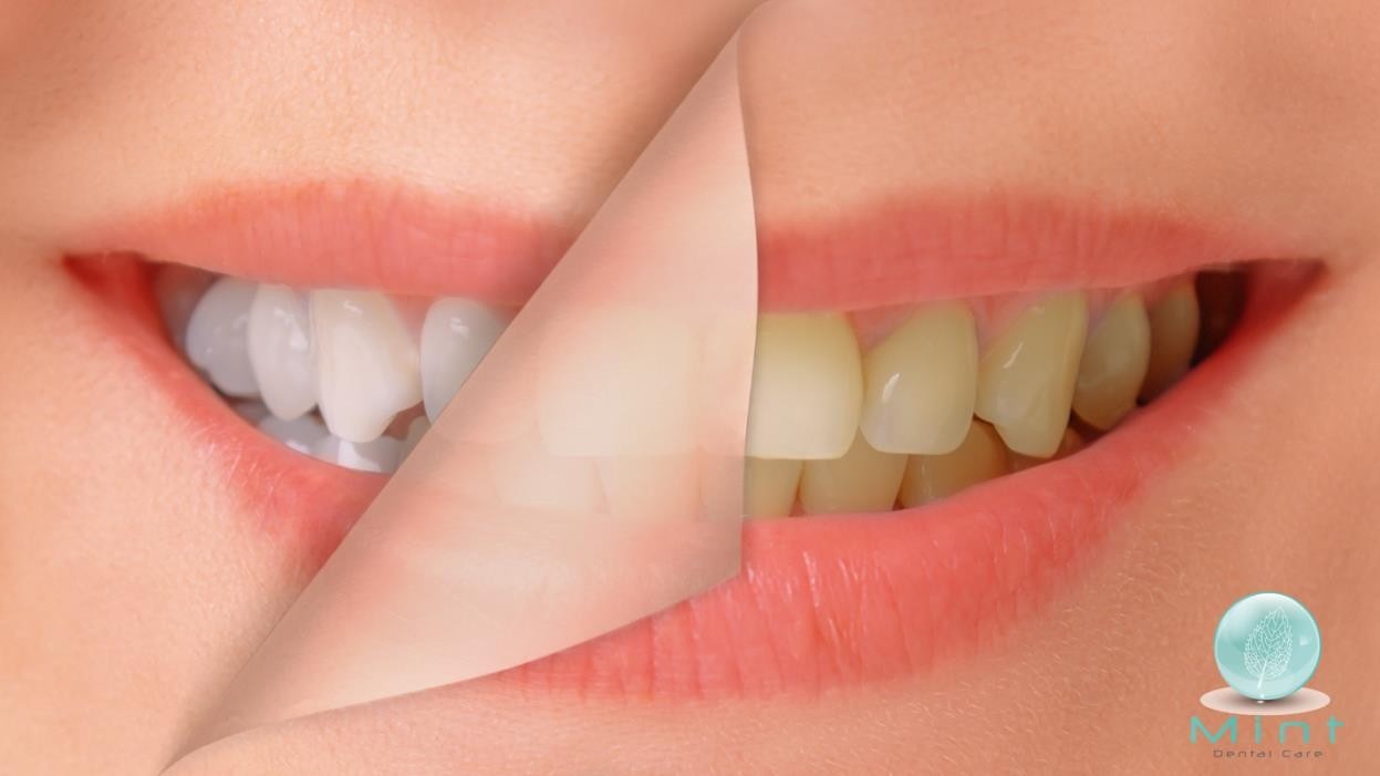 How to Whiten Teeth: 5 Ways to Brighten your Smile