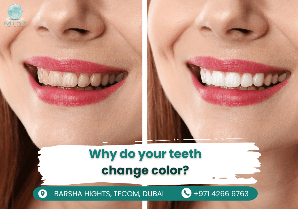 Illustration showing how coffee, tobacco, and aging cause tooth discoloration by staining enamel over time, compared to healthy white teeth.