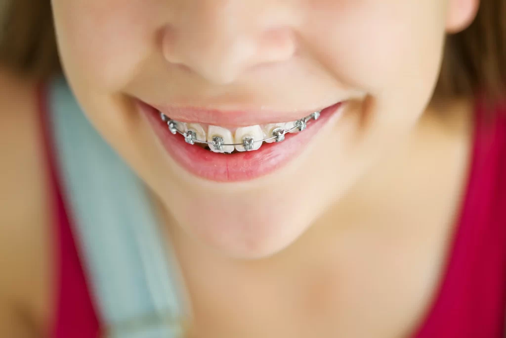 Patient with discreet braces at Mint Dental Care
