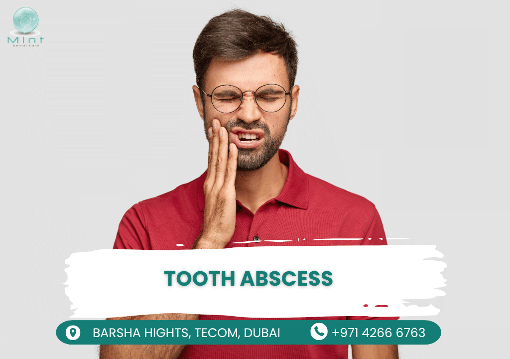 Illustration showing infection spreading from tooth pulp to root tip, causing abscess with swollen gums and bone loss risk.