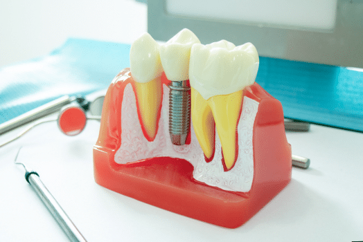 How Can I Keep My Teeth White