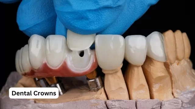 Dental Crowns