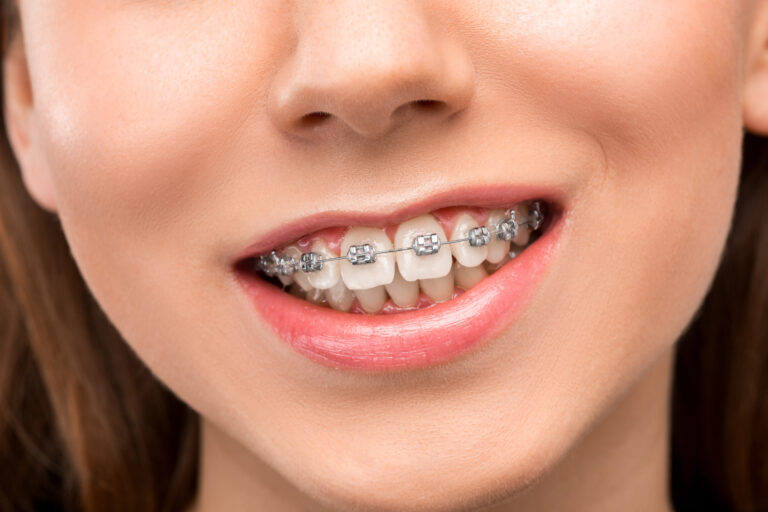 Patient with Damon braces at Mint Dental Care