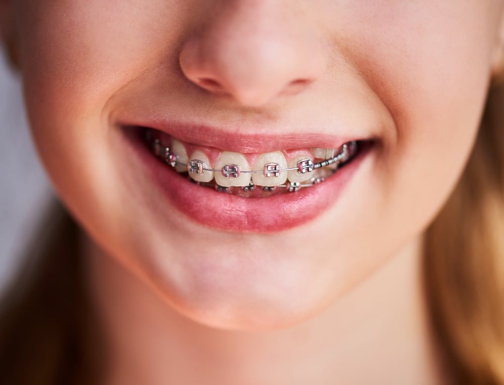  Traditional metal braces on a patient’s teeth