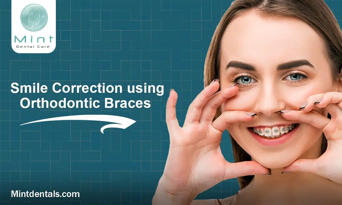 Smile Correction using Orthodontic Braces