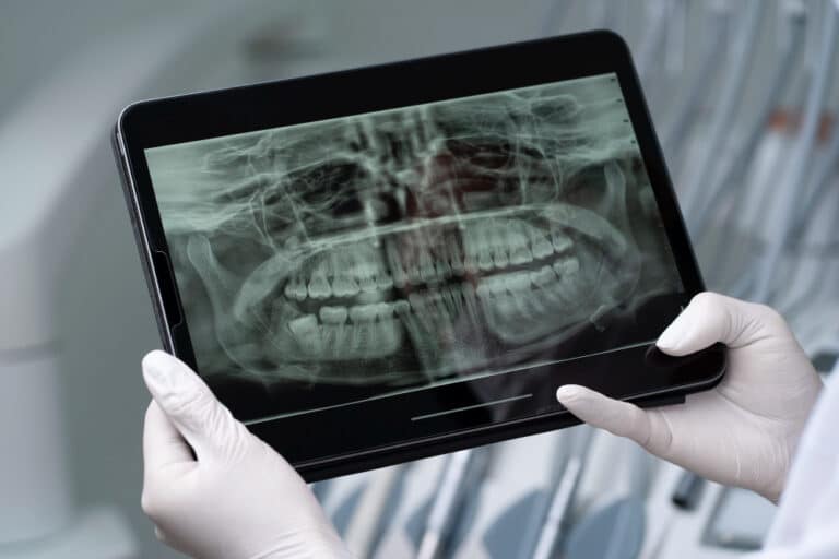 Dental X-ray used to assess impacted wisdom teeth