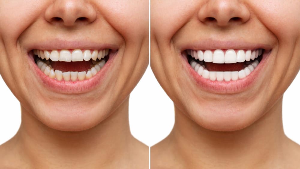 Before and after comparison of teeth treated with composite bonding