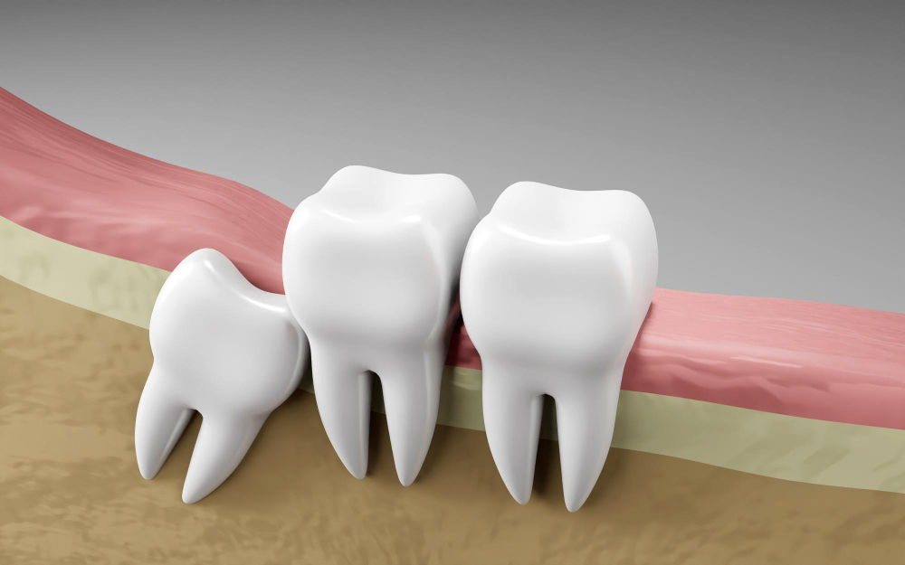 "wisdom tooth impaction diagram