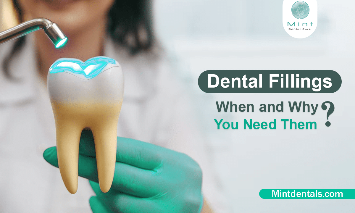 Dental Fillings When and Why You Need Them