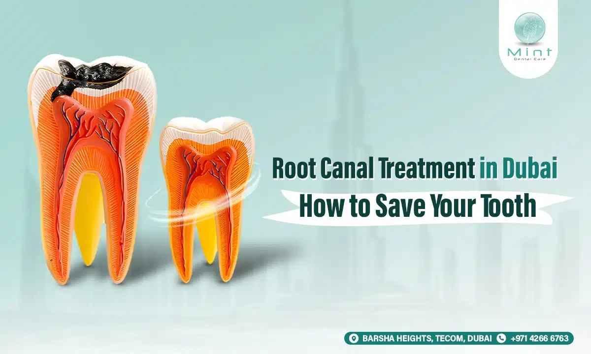 Root Canal Treatment in Dubai How to Save Your Tooth