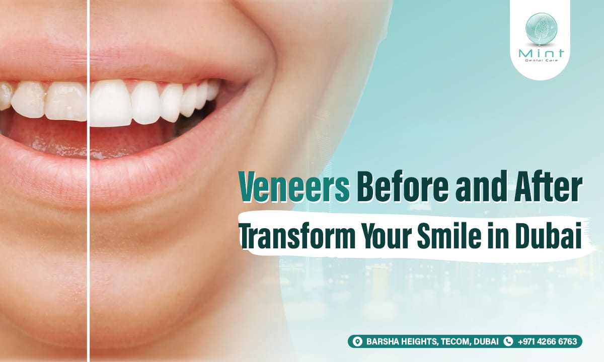 Veneers Before and After: Transform Your Smile in Dubai