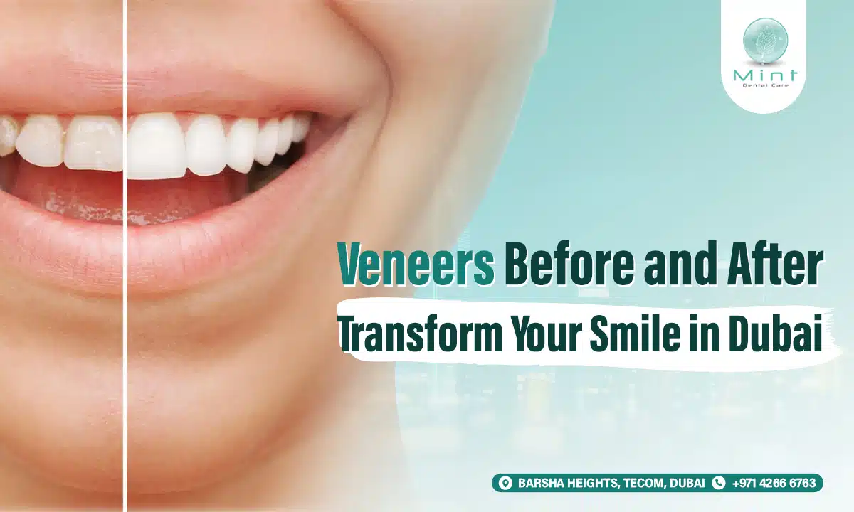 Veneers Before and After: Transform Your Smile in Dubai