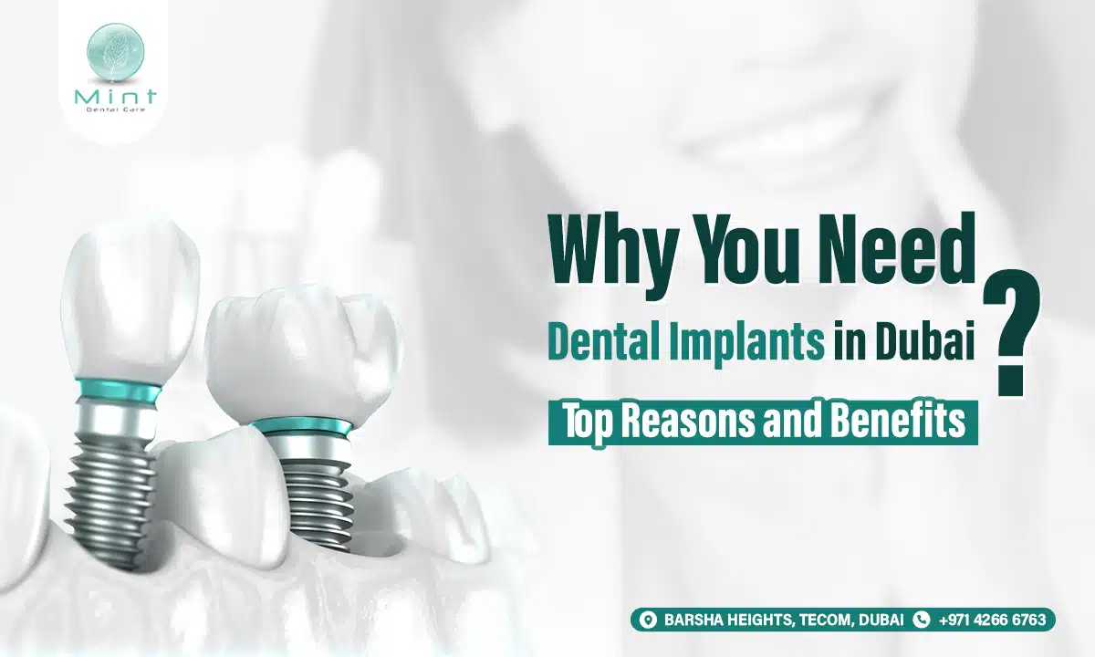 Why You Need Dental Implants in Dubai: Top Reasons and Benefits