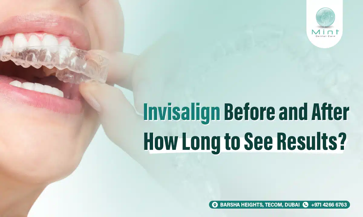 Invisalign Before and After: How Long to See Results?