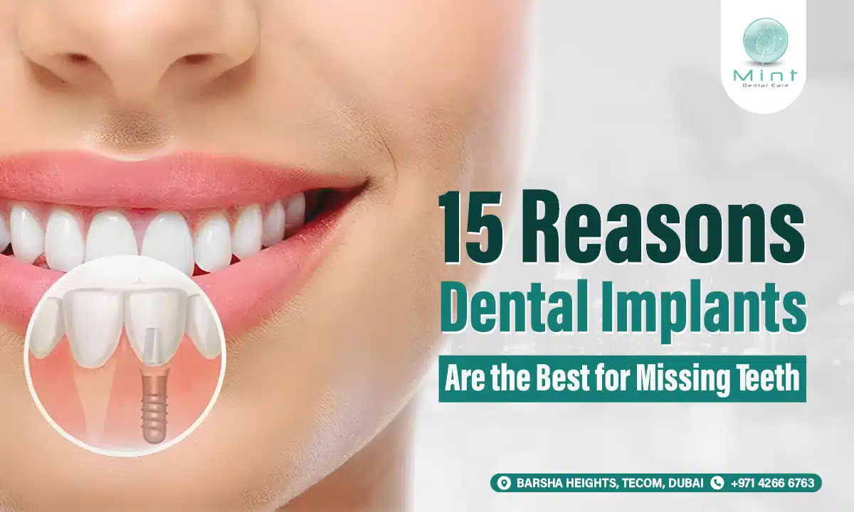 15 Reasons Dental Implants Are the Best for Missing Teeth in Dubai