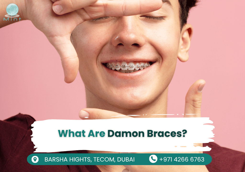 Close-up of Damon Braces, a self-ligating orthodontic system with a slide mechanism instead of elastic bands, offering faster and more comfortable teeth straightening.