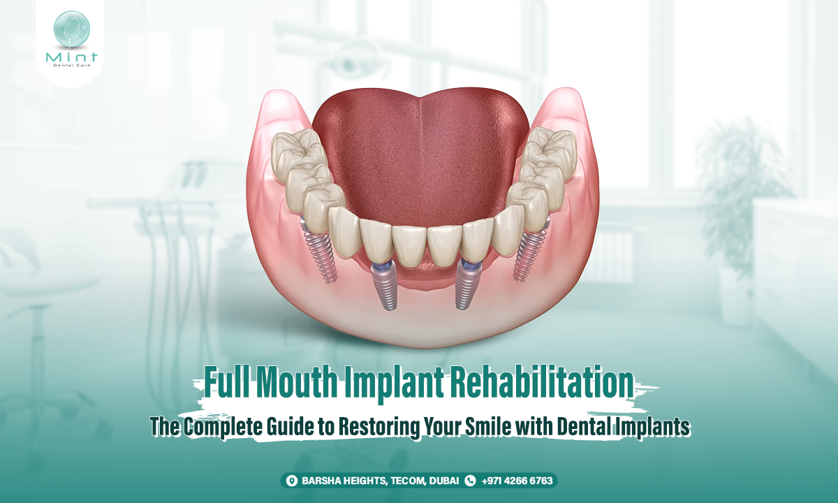 Full Mouth Implant Rehabilitation: The Complete Guide to Restoring Your Smile with Dental Implants