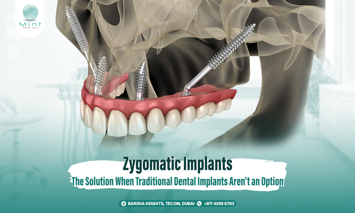 Zygomatic Implants: The Solution When Traditional Dental Implants Aren’t an Option