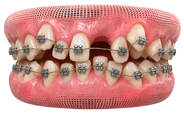 Braces in Dubai | Damon, Ceramic, Lingual