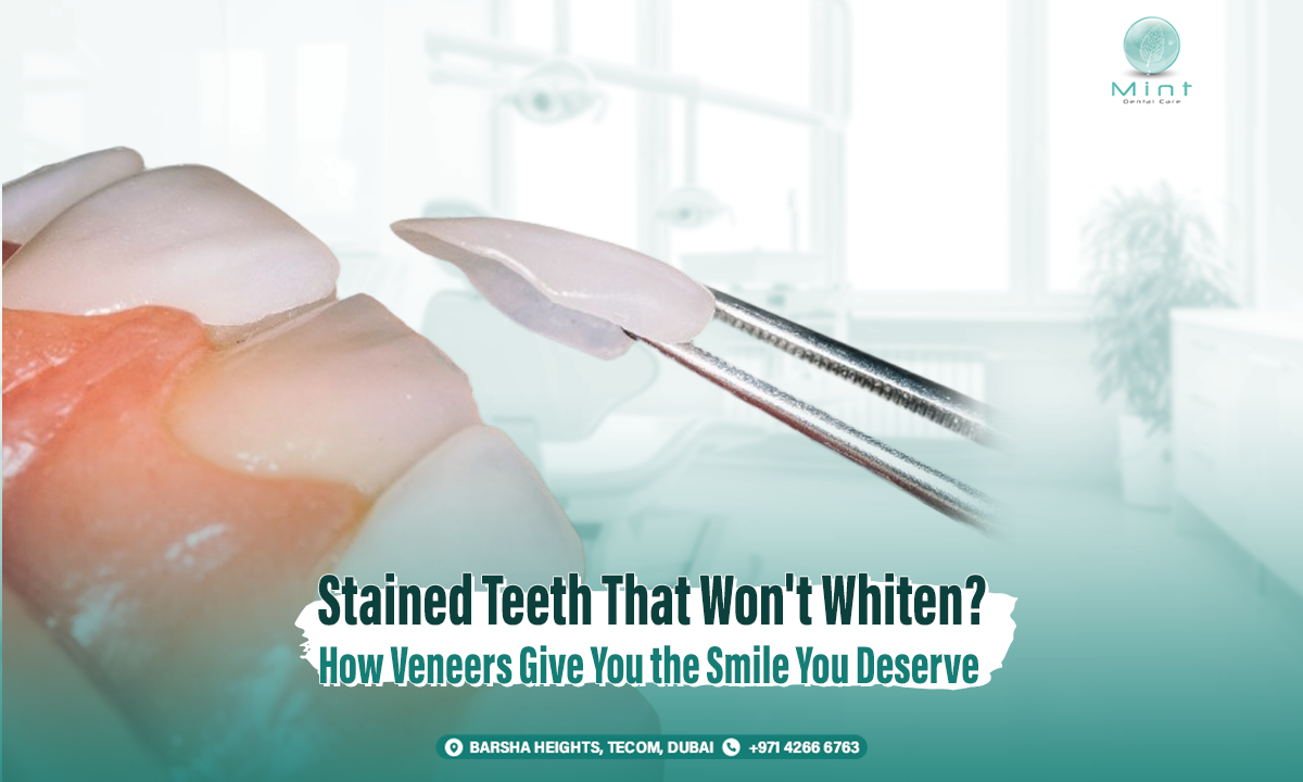 Stained Teeth That Won’t Whiten? How Veneers Give You the Smile You Deserve