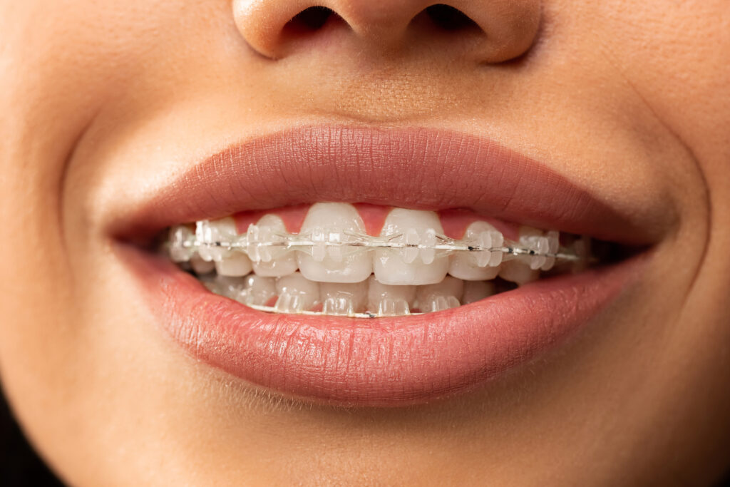 Beautiful young woman with teeth braces pink