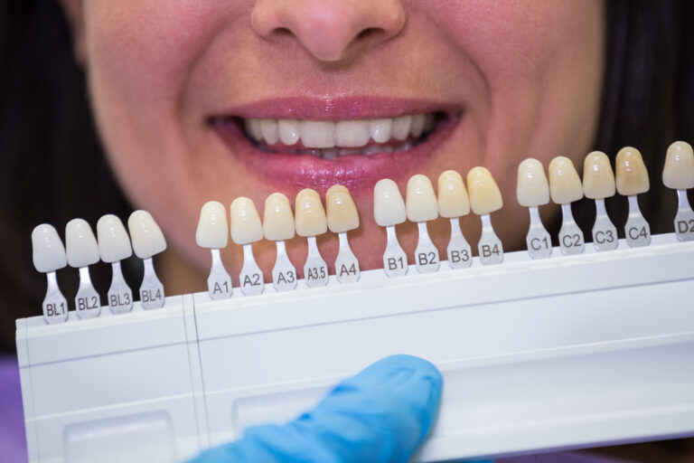 استشارة مريضة لإزالة ملغم الأسنان في Mint Dental Care