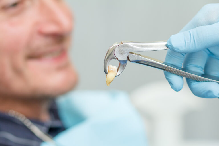 خلع الأسنان الجراحي في Mint Dental Care في دبي