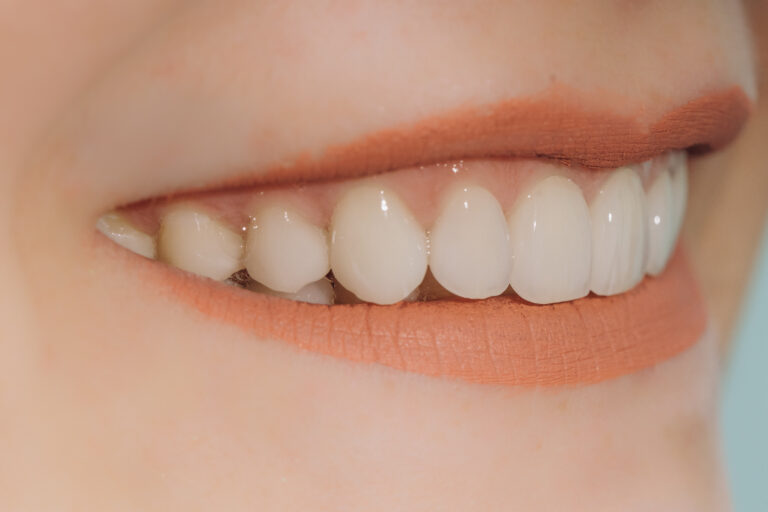 Digital Smile Design preview of a finished smile