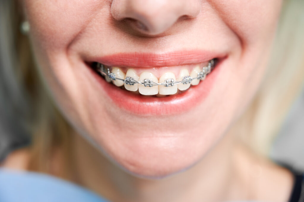 Close-up of a smile with metal braces at Mint Dental Care in Dubai
