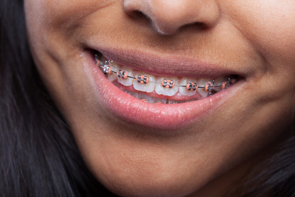Woman smiling with teeth apparatus