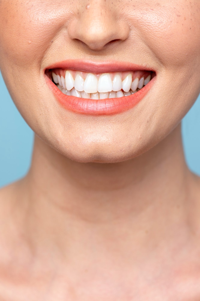 تصميم ابتسامة هوليوود في Mint Dental Care